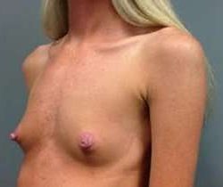 Breast Augmentation Before & After Patient #904
