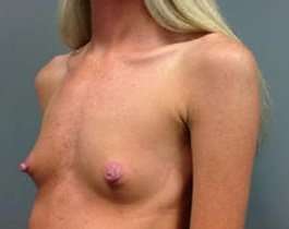 Breast Augmentation Before & After Patient #904