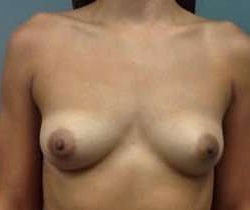 Breast Augmentation Before & After Patient #911