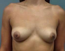 Breast Augmentation Before & After Patient #911