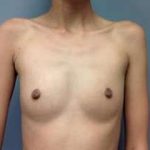 Breast Augmentation Before & After Patient #918