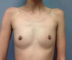 Breast Augmentation Before & After Patient #918