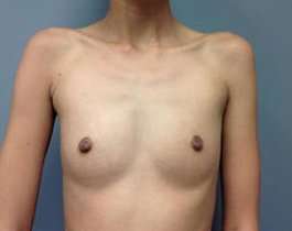 Breast Augmentation Before & After Patient #918