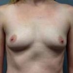 Breast Augmentation Before & After Patient #925