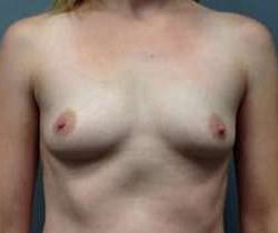 Breast Augmentation Before & After Patient #925