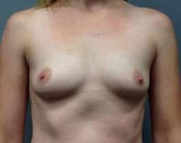 Breast Augmentation Before & After Patient #925