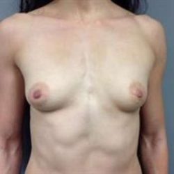 Breast Augmentation Before & After Patient #932