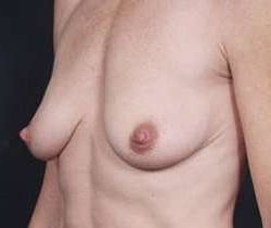 Breast Mastopexy Before & After Patient #141