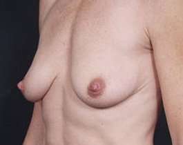 Breast Mastopexy Before & After Patient #141