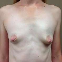 Breast Augmentation Before & After Patient #952