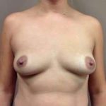 Breast Augmentation Before & After Patient #959