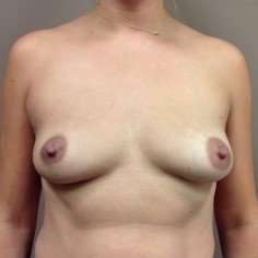 Breast Augmentation Before & After Patient #959