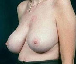 Breast Mastopexy Before & After Patient #148