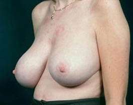 Breast Mastopexy Before & After Patient #148