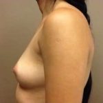 Breast Augmentation Before & After Patient #1003