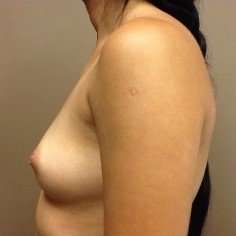 Breast Augmentation Before & After Patient #1003