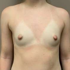 Breast Augmentation Before & After Patient #1015