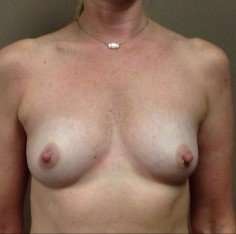 Breast Augmentation Before & After Patient #1022