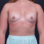 Breast Augmentation Before & After Patient #1027