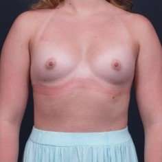 Breast Augmentation Before & After Patient #1027