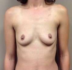 Breast Augmentation Before & After Patient #1034
