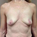 Breast Augmentation Before & After Patient #1058
