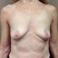 Breast Augmentation Before & After Patient #1058