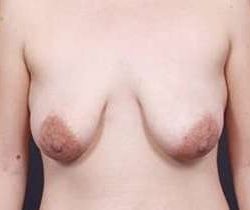 Breast Mastopexy Before & After Patient #155