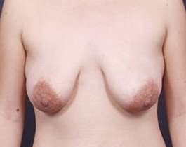 Breast Mastopexy Before & After Patient #155