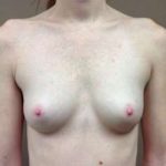 Breast Augmentation Before & After Patient #1070