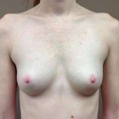 Breast Augmentation Before & After Patient #1070