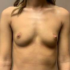 Breast Augmentation Before & After Patient #1096