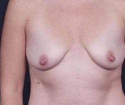 Breast Mastopexy Before & After Patient #162