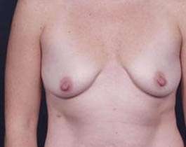 Breast Mastopexy Before & After Patient #162