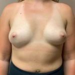 Breast Augmentation Before & After Patient #1128