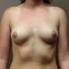 Breast Augmentation Before & After Patient #1142