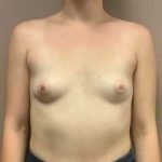 Breast Augmentation Before & After Patient #1147