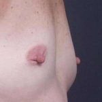Breast Miscellaneous Before & After Patient #75