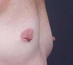 Breast Miscellaneous Before & After Patient #75