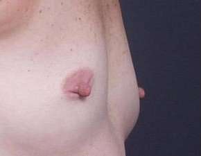 Breast Miscellaneous Before & After Patient #75