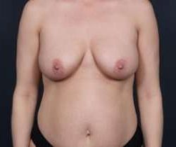 Breast Mastopexy Before & After Patient #169