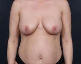 Breast Mastopexy Before & After Patient #169