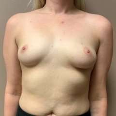 Breast Augmentation Before & After Patient #1189