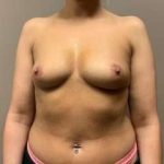 Breast Augmentation Before & After Patient #1196