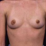 Breast Augmentation Before & After Patient #1210