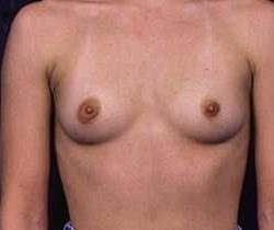 Breast Augmentation Before & After Patient #1210