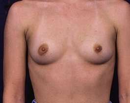 Breast Augmentation Before & After Patient #1210
