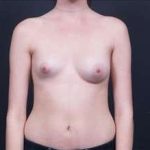 Breast Asymmetry Before & After Patient #1215