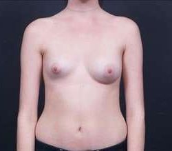 Breast Asymmetry Before & After Patient #1215