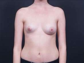 Breast Asymmetry Before & After Patient #1215